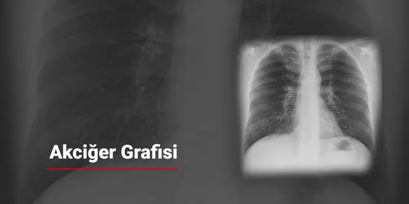 Akciğer Grafisi Nedir? Ne Zaman Çekilir?