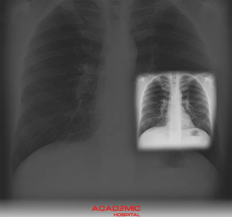 What Is a Chest X-ray? When Is It Taken?