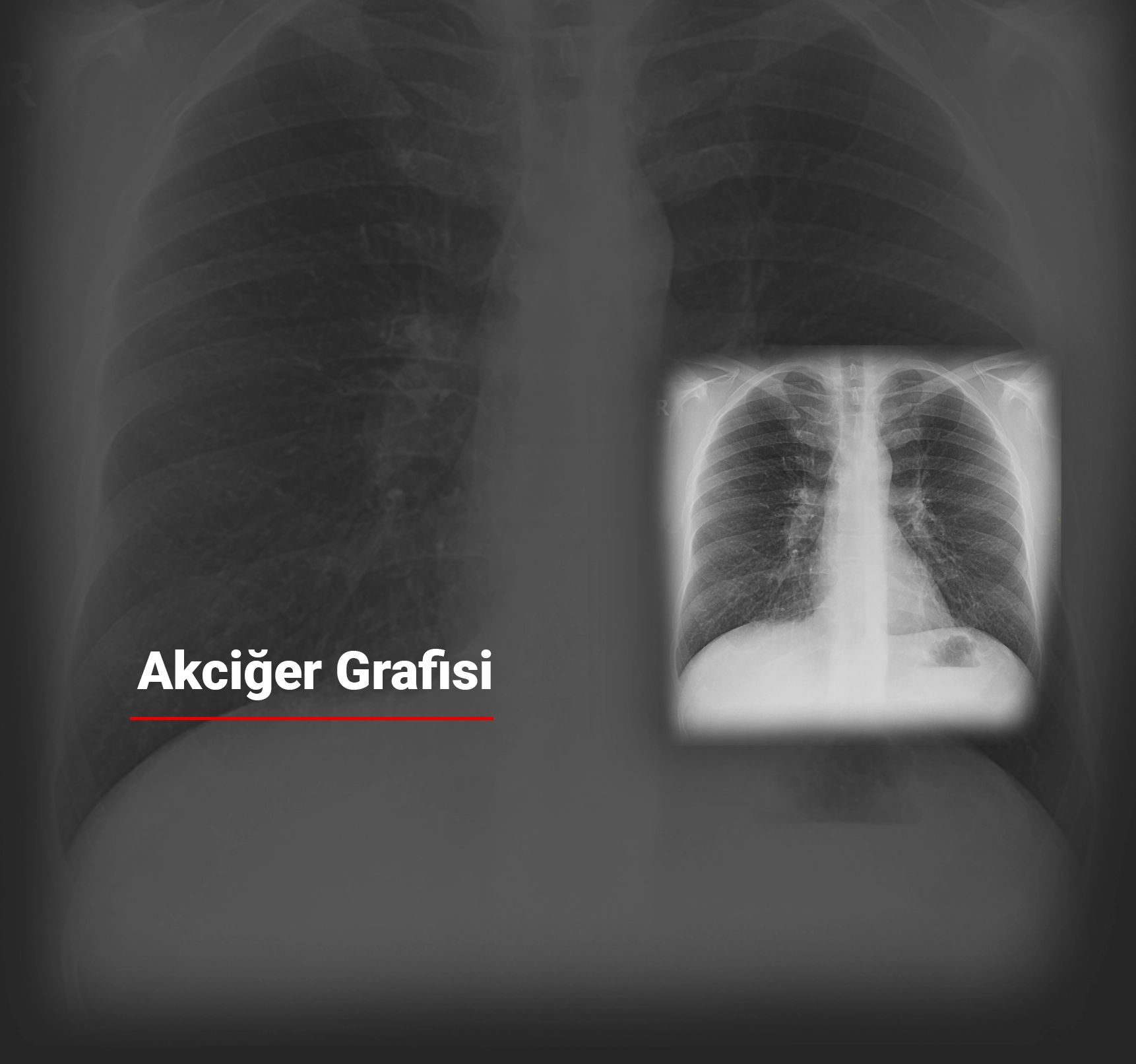 Akciğer Grafisi Nedir? Ne Zaman Çekilir?