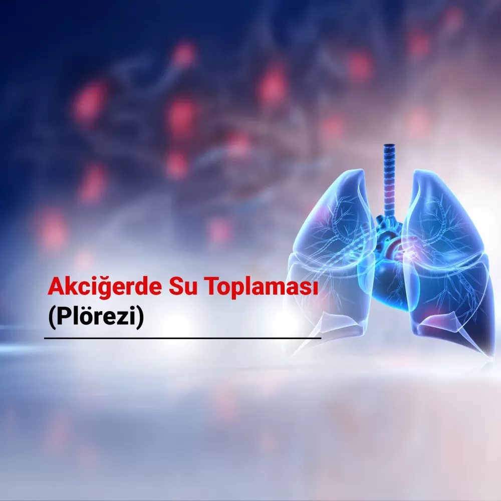Akciğerde Su Toplaması (Plörezi): Belirtileri, Nedenleri ve Tedavi Yöntemleri