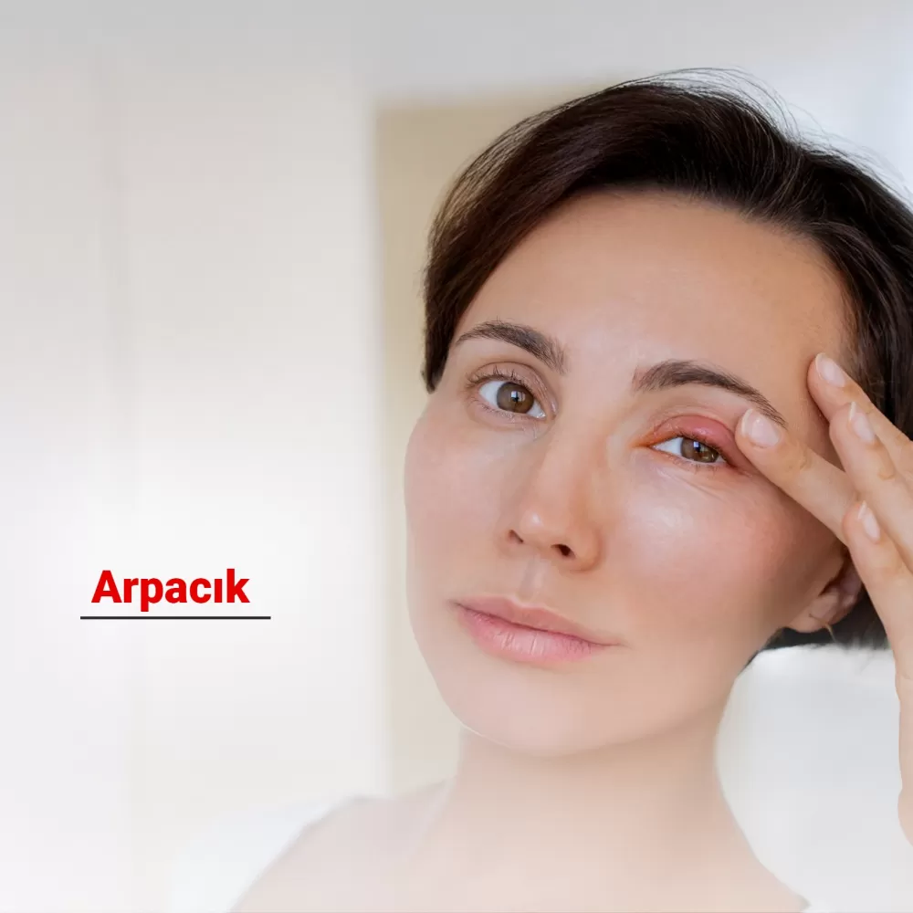 Arpacık (Göz Arpacığı) Nedir? Belirtileri ve Tedavi Yöntemleri Nelerdir?