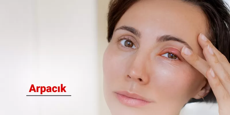 Arpacık (Göz Arpacığı) Nedir? Belirtileri ve Tedavi Yöntemleri Nelerdir?