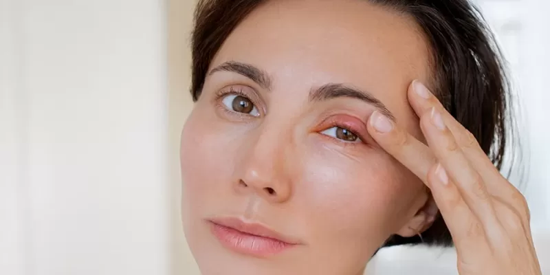 What Is a Stye? What Are Its Symptoms and Treatment Methods?
