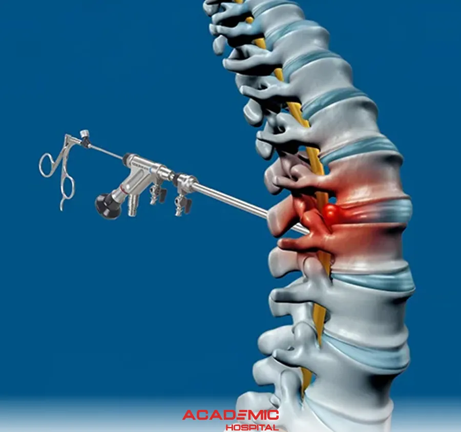Lumbar Disc Herniation and Fully Closed Lumbar Disc Surgery: Endoscopic Discectomy