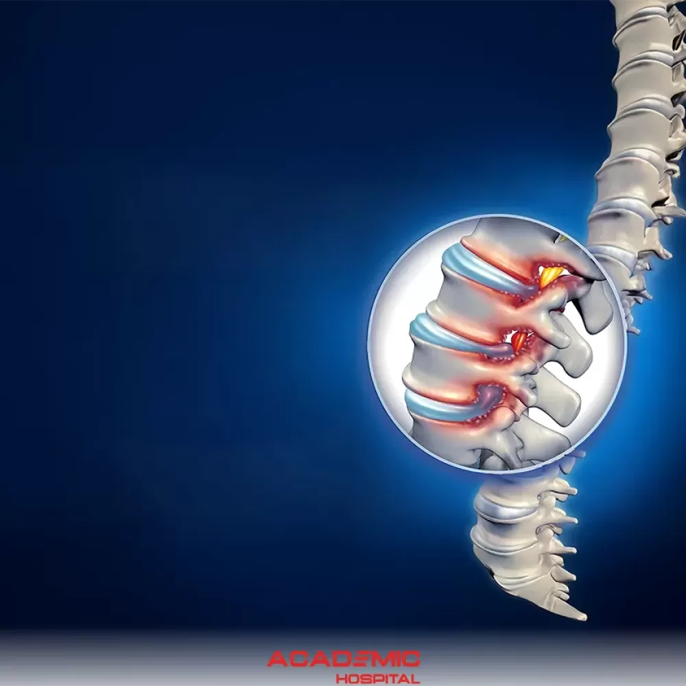 Belde Dar Kanal (Spinal Stenoz) Nedir? Belirtileri, Nedenleri ve Tedavi Yöntemleri