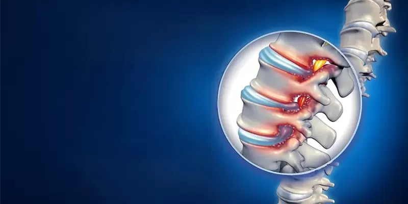 Belde Dar Kanal (Spinal Stenoz) Nedir? Belirtileri, Nedenleri ve Tedavi Yöntemleri
