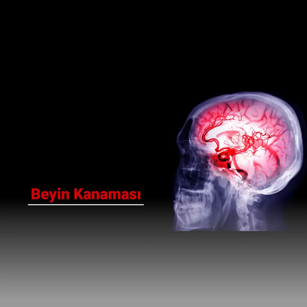 Beyin Kanaması Nedir? Belirtileri, Nedenleri ve Tedavi Yöntemleri Nelerdir?