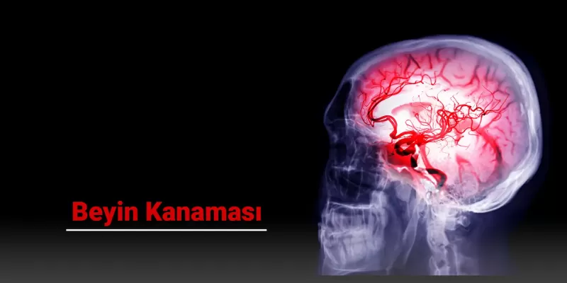Beyin Kanaması Nedir? Belirtileri, Nedenleri ve Tedavi Yöntemleri Nelerdir?