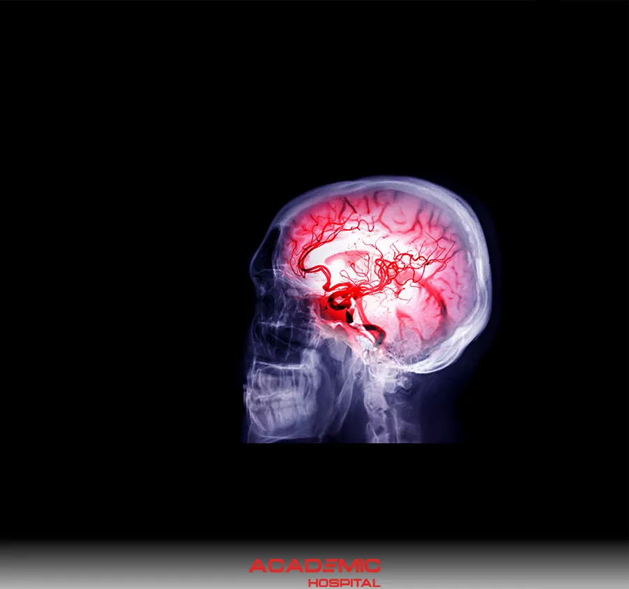 What Is a Brain Hemorrhage? What Are Its Symptoms, Causes, and Treatment Methods?