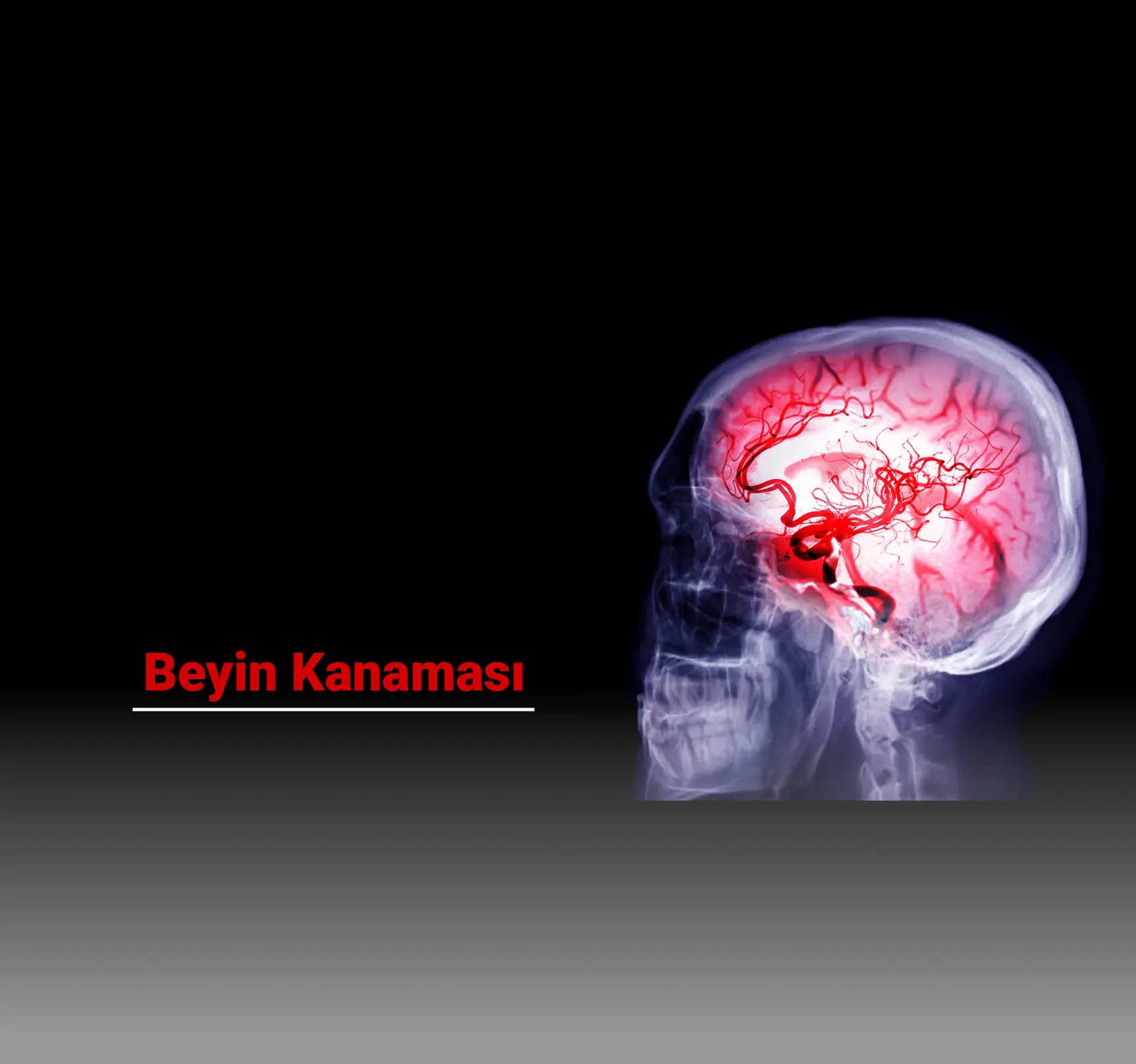 Beyin Kanaması Nedir? Belirtileri, Nedenleri ve Tedavi Yöntemleri Nelerdir?