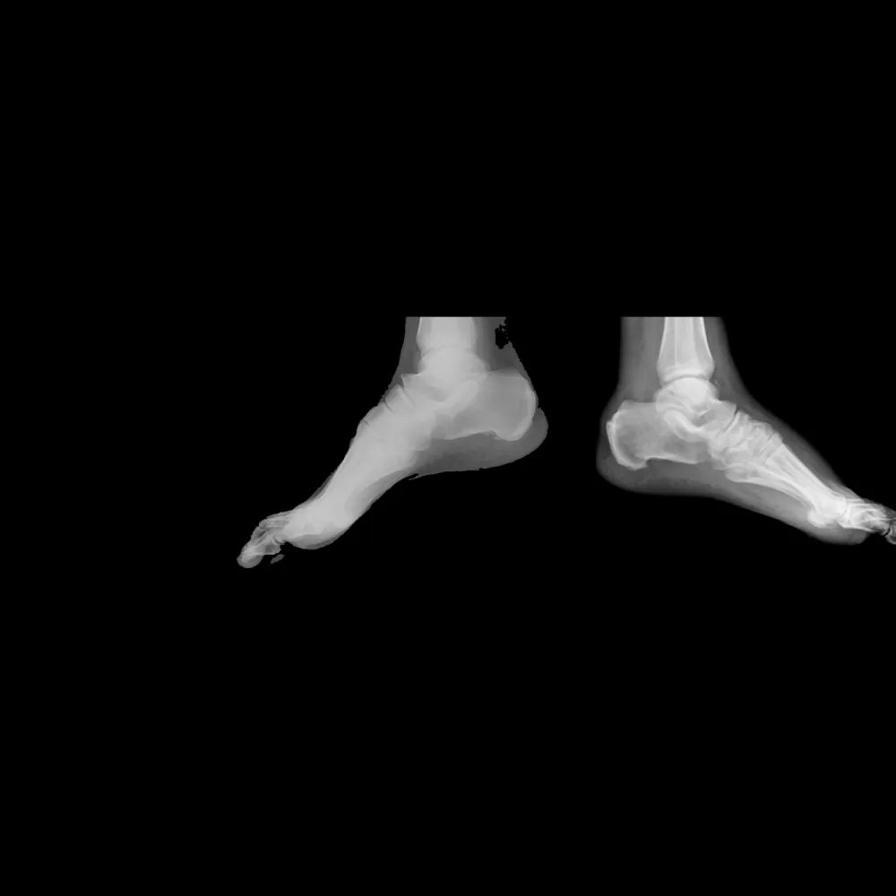 Charcot Artropatisi Nedir? Belirtileri ve Tedavi Yöntemleri