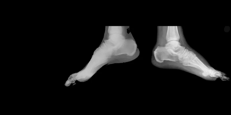 Charcot Artropatisi Nedir? Belirtileri ve Tedavi Yöntemleri