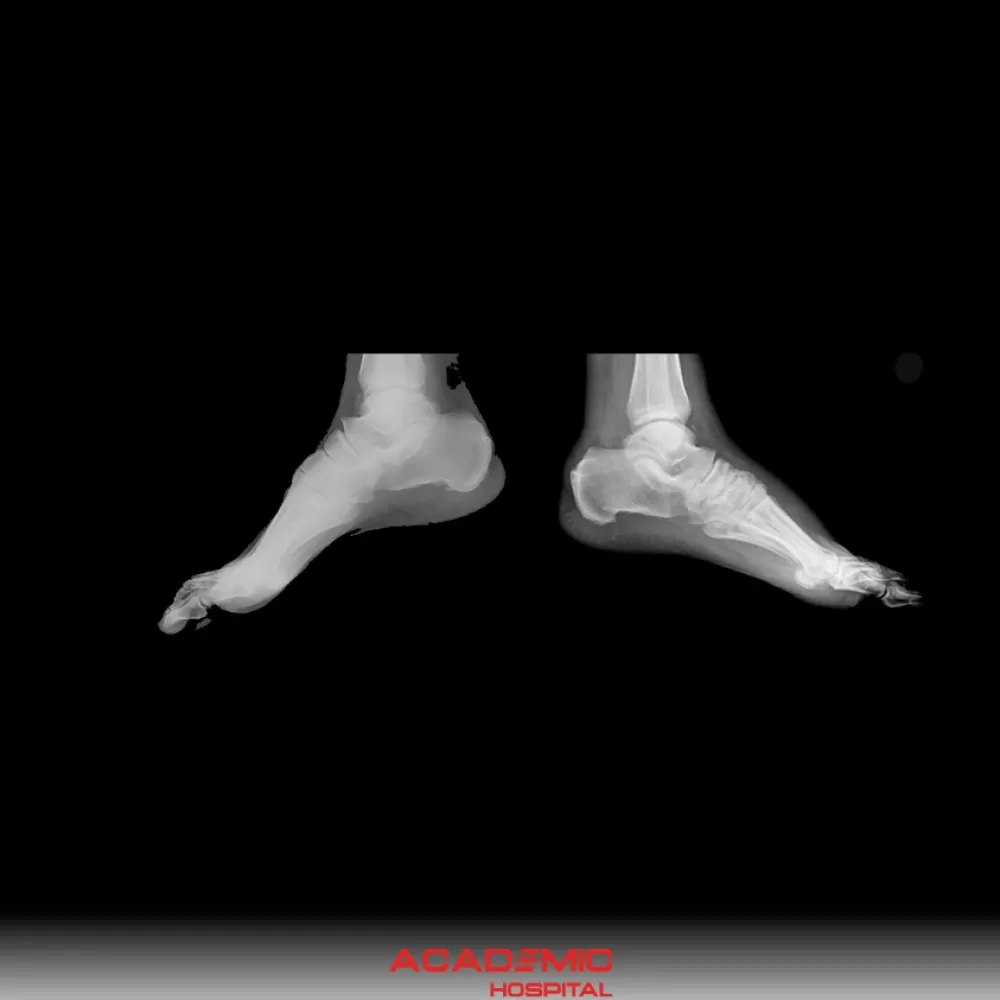 Charcot Artropatisi Nedir? Belirtileri ve Tedavi Yöntemleri