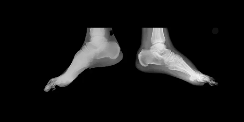 Charcot Artropatisi Nedir? Belirtileri ve Tedavi Yöntemleri