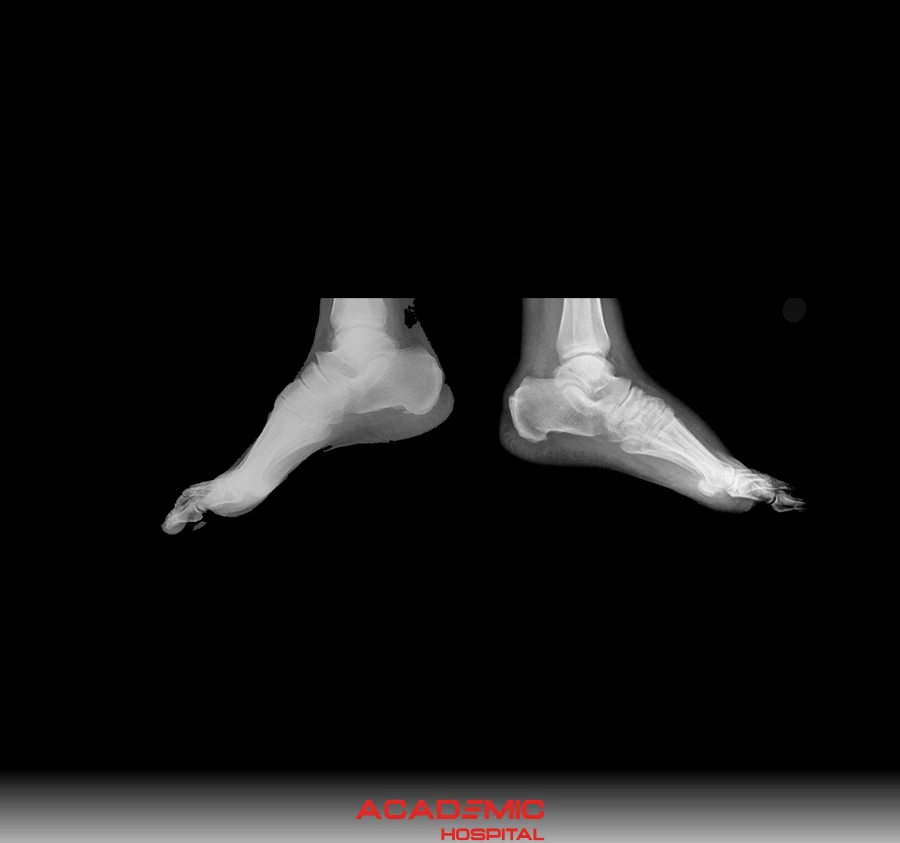 Charcot Artropatisi Nedir? Belirtileri ve Tedavi Yöntemleri