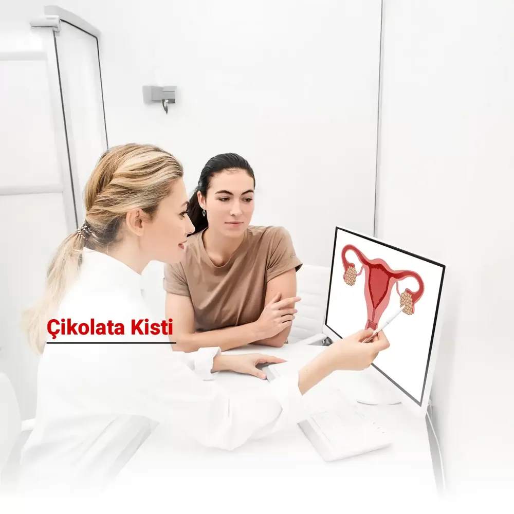 Çikolata Kisti (Endometriozis) Nedir? Belirtileri, Nedenleri ve Tedavi Yöntemleri Nelerdir?
