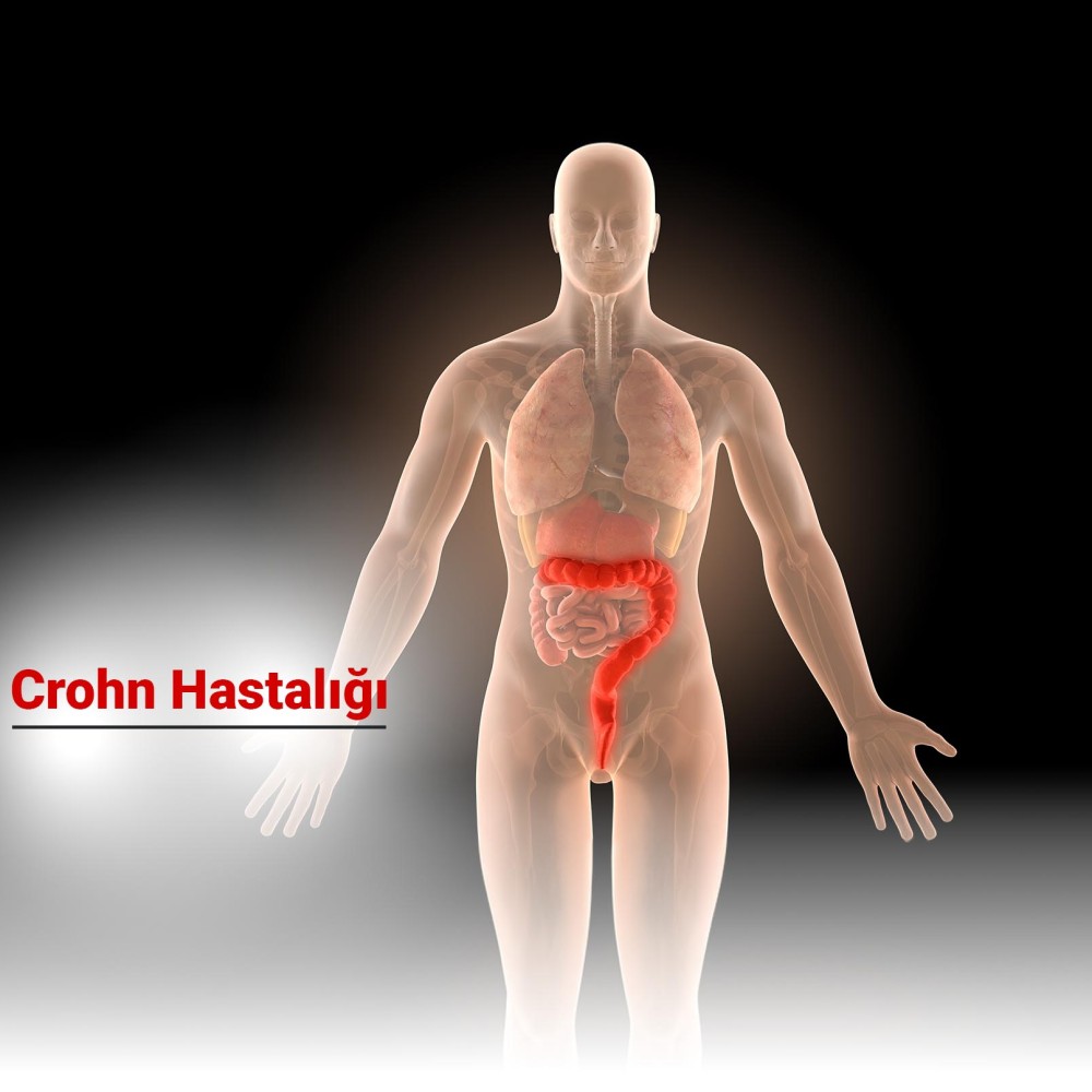 Crohn Hastalığı
