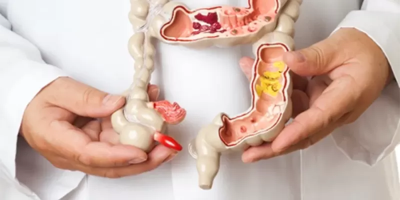 Crohn's Disease