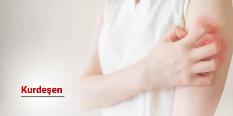 Kurdeşen Nedir?