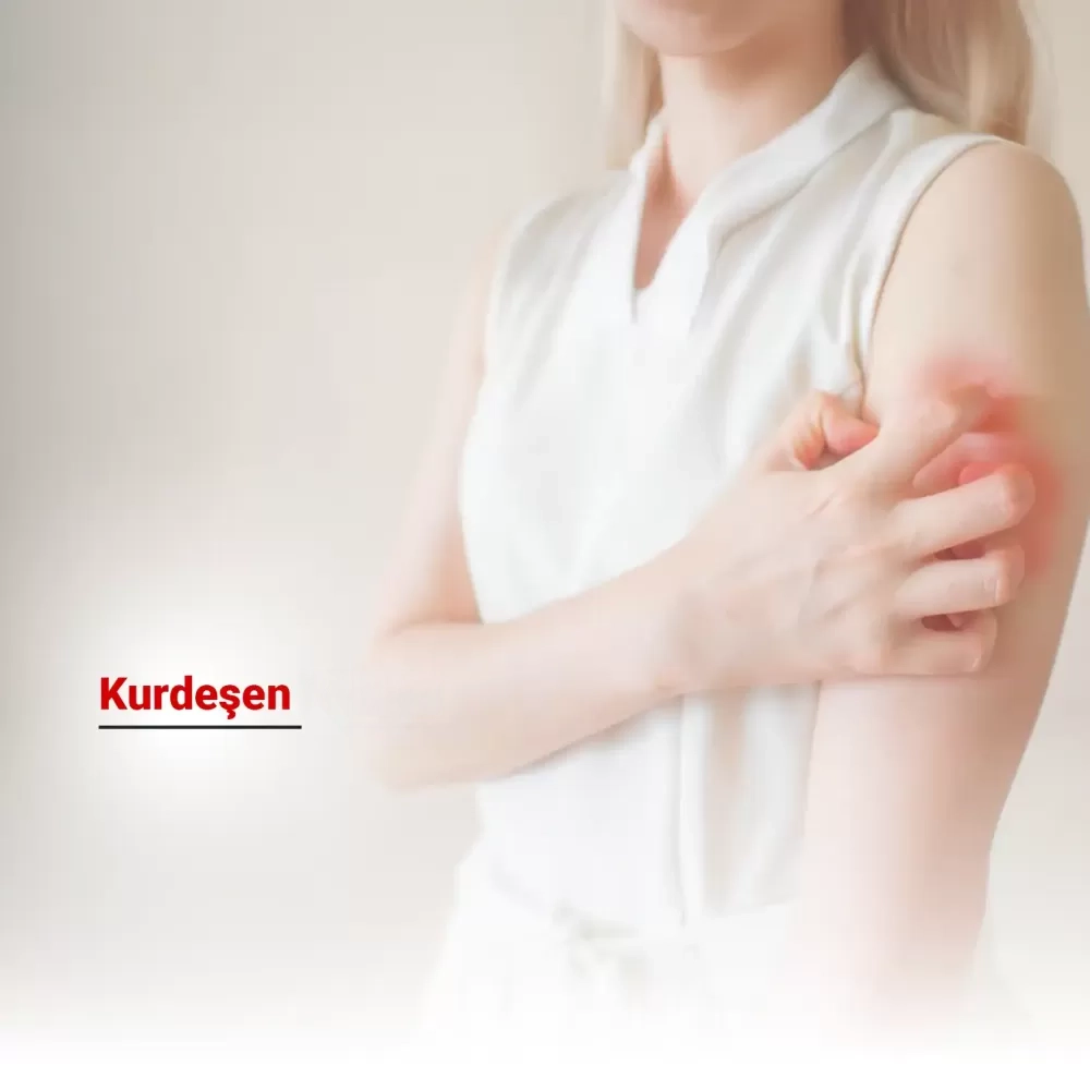 Kurdeşen Nedir?