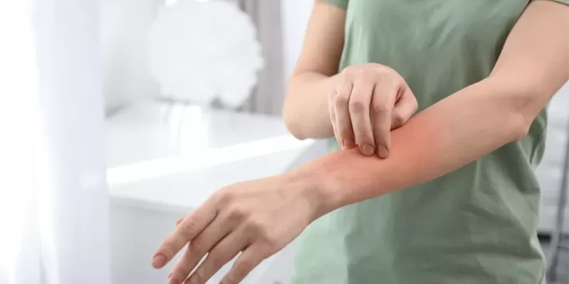 What Is Eczema? Types, Symptoms, and Treatment