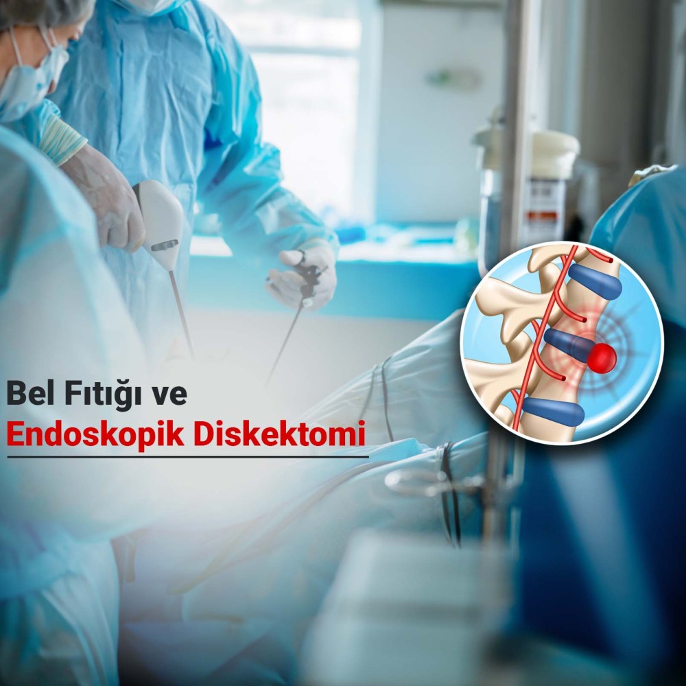 Bel Fıtığı ve Tam Kapalı Bel Fıtığı Ameliyatı: Endoskopik Diskektomi