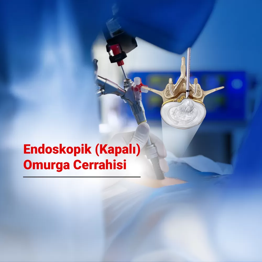 Endoskopik (Kapalı) Omurga Cerrahisi Nedir? Avantajları, Uygulama Alanları Nelerdir?