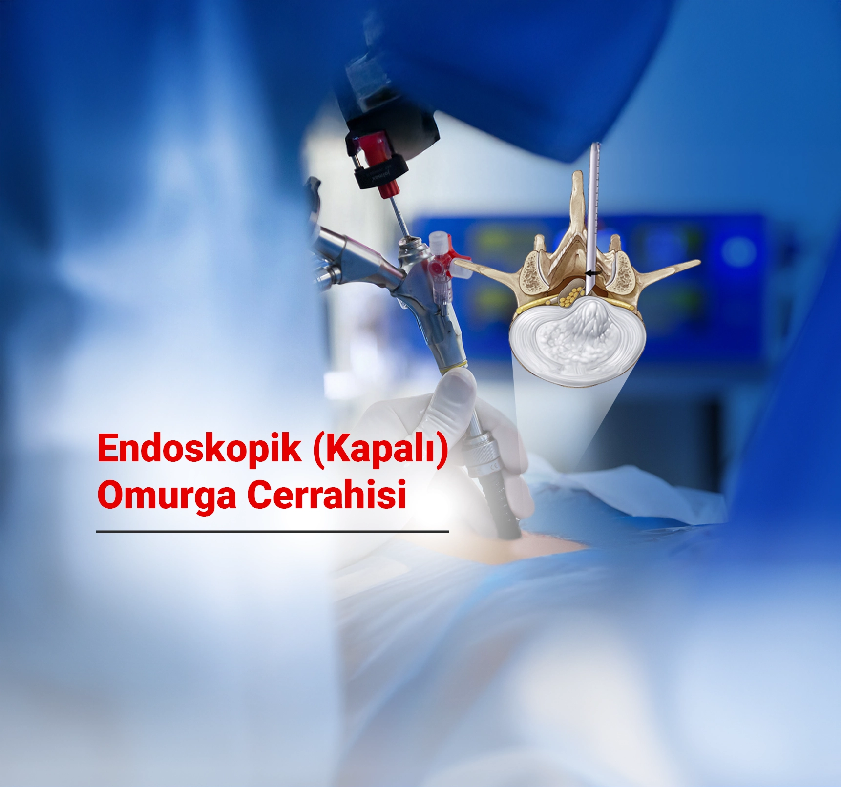 Endoskopik (Kapalı) Omurga Cerrahisi Nedir? Avantajları, Uygulama Alanları Nelerdir?