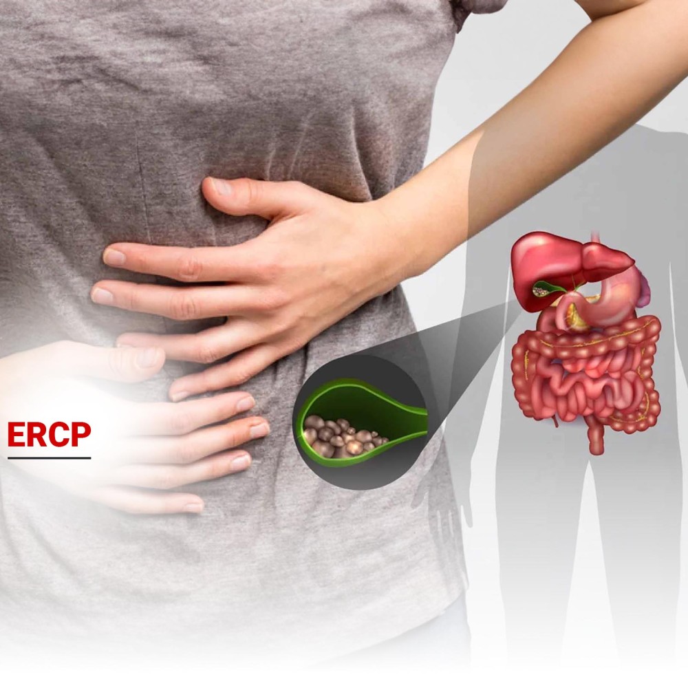 ERCP Nedir? Nasıl Yapılır? 