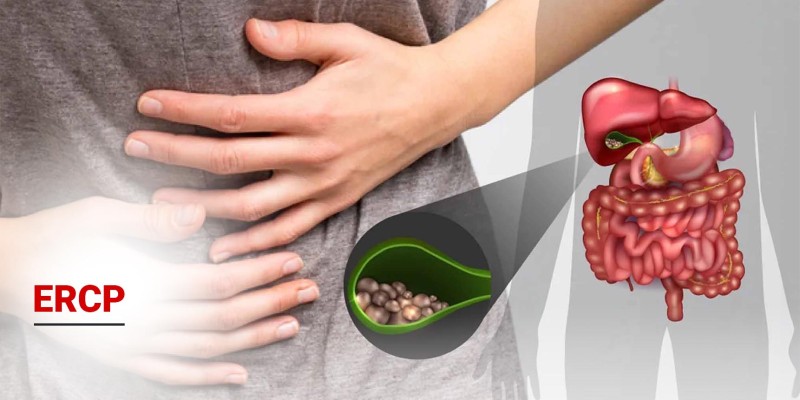 ERCP Nedir? Nasıl Yapılır? 