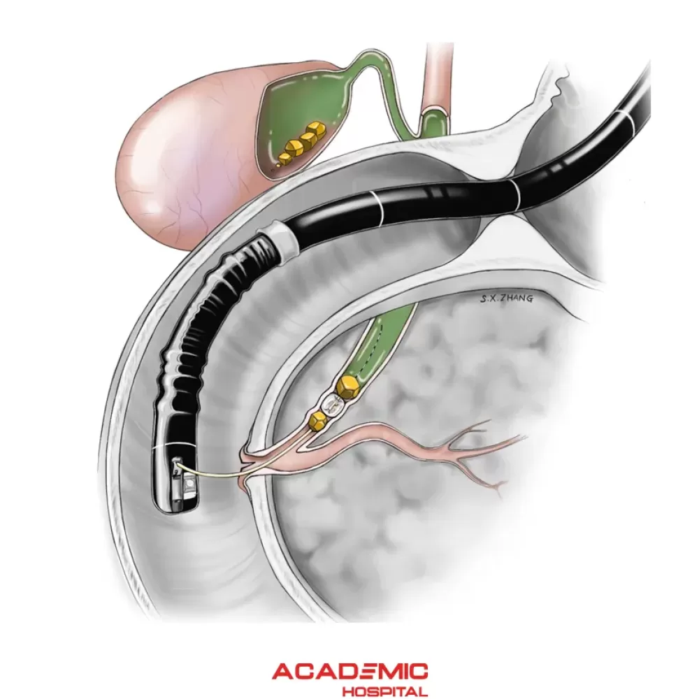 ERCP Nedir? Nasıl Yapılır? 