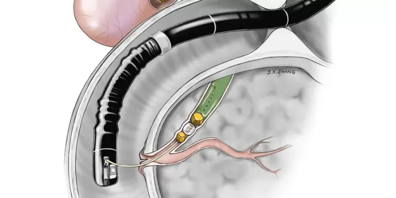 What is ERCP? How is it performed?