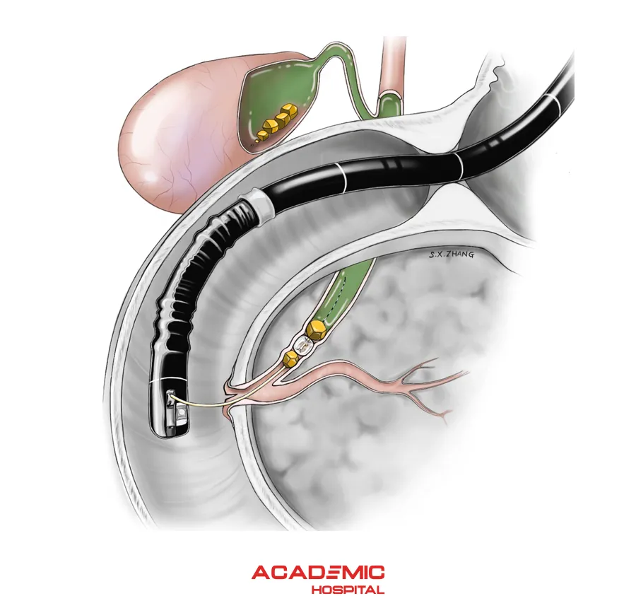 What is ERCP? How is it performed?
