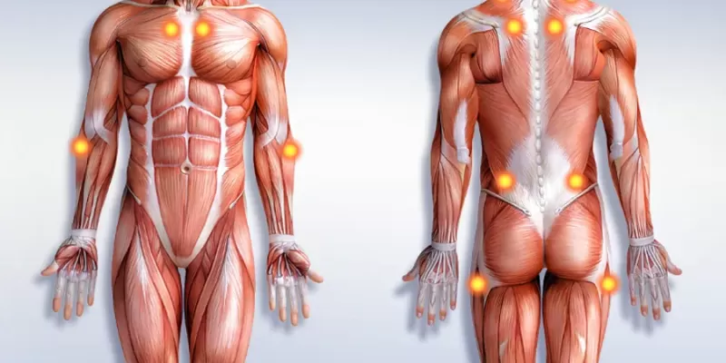 Fibromiyalji Nedir? Belirtileri Nelerdir? Tedavi Yöntemleri Nelerdir?
