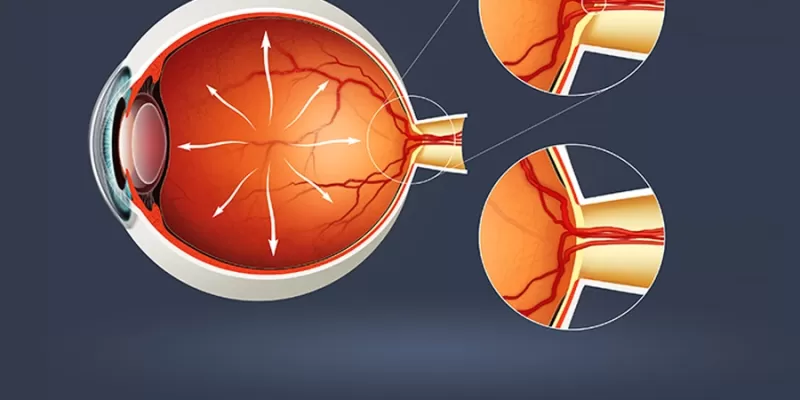 What Is Glaucoma (Eye Pressure)?