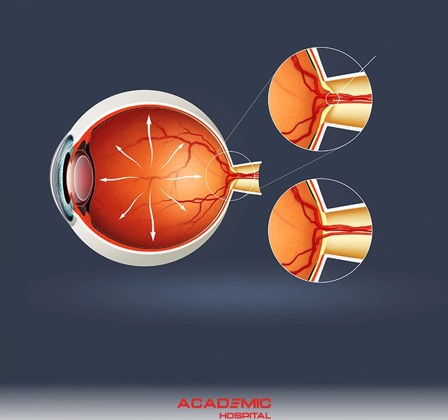 What Is Glaucoma (Eye Pressure)?