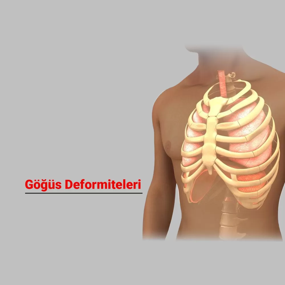 Göğüs Deformiteleri: Nedenleri, Belirtileri ve Tedavi Yöntemleri