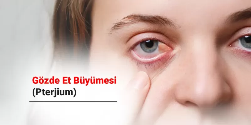 Gözde Et Büyümesi (Pterjium) Nedir? Belirtileri ve Tedavi Yöntemleri