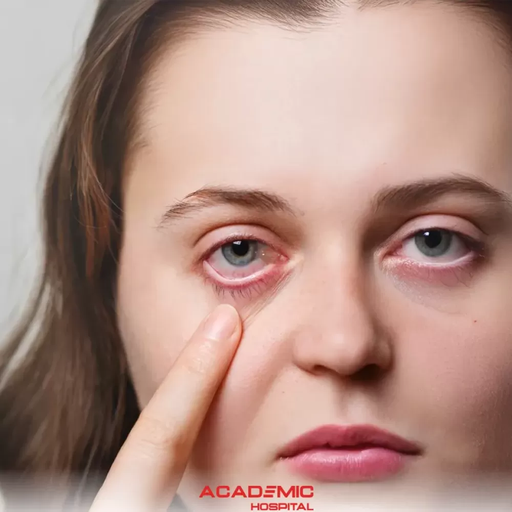Gözde Et Büyümesi (Pterjium) Nedir? Belirtileri ve Tedavi Yöntemleri