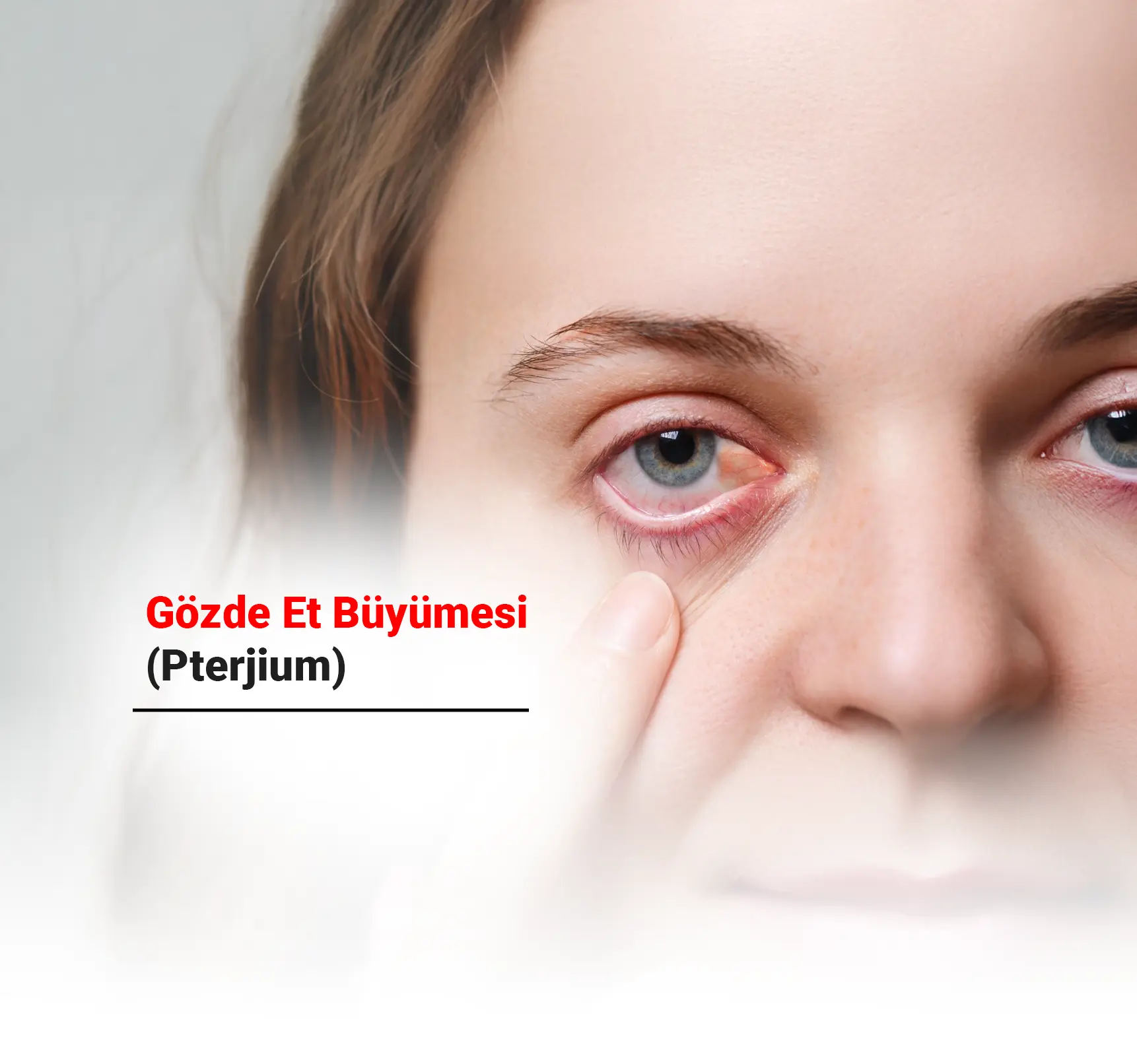 Gözde Et Büyümesi (Pterjium) Nedir? Belirtileri ve Tedavi Yöntemleri