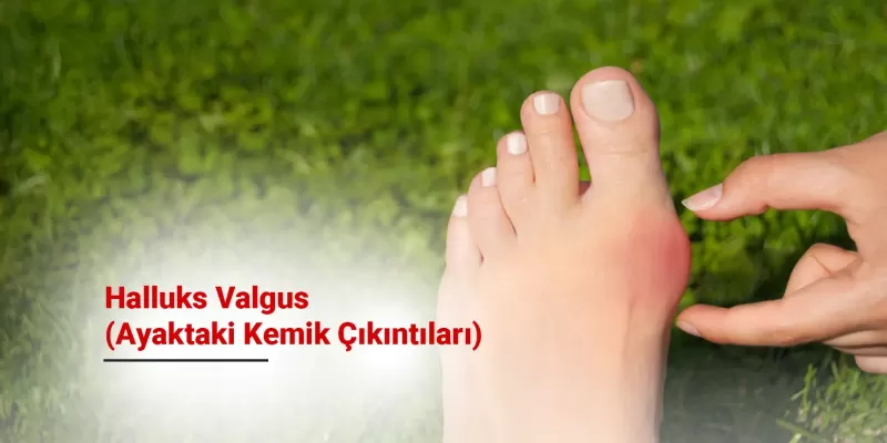 Halluks Valgus (Ayakta Kemik Çıkıntısı) Nedir? Belirtileri, Nedenleri ve Tedavi Yöntemleri