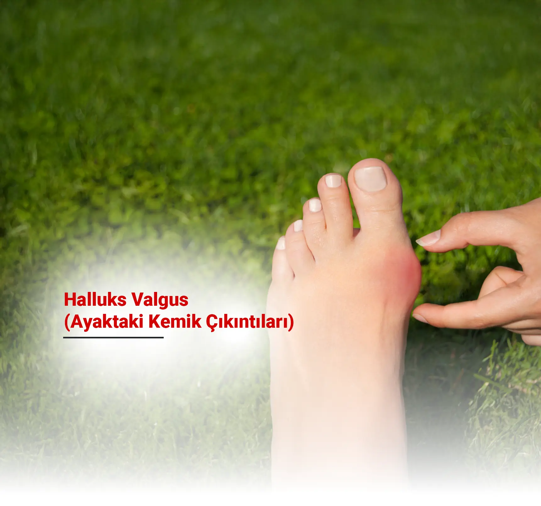 Halluks Valgus (Ayakta Kemik Çıkıntısı) Nedir? Belirtileri, Nedenleri ve Tedavi Yöntemleri