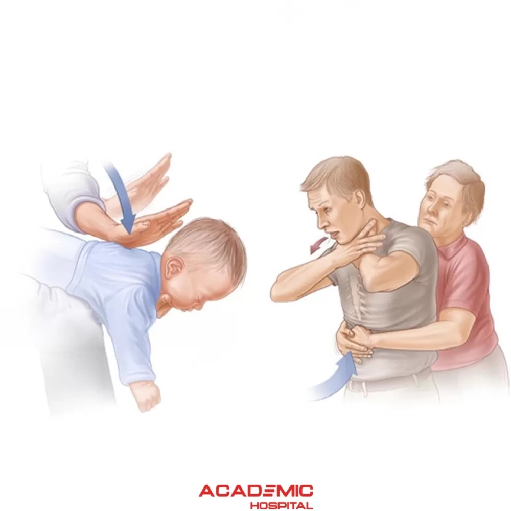 What Is the Heimlich Maneuver and How Is It Performed?