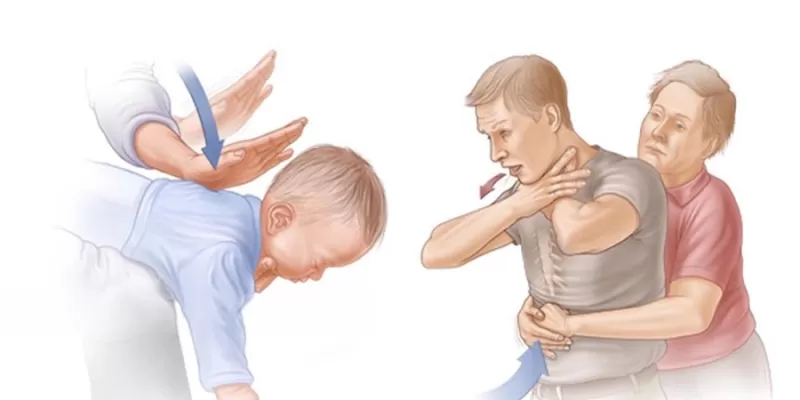 Heimlich Manevrası Nedir ve Nasıl Uygulanır?