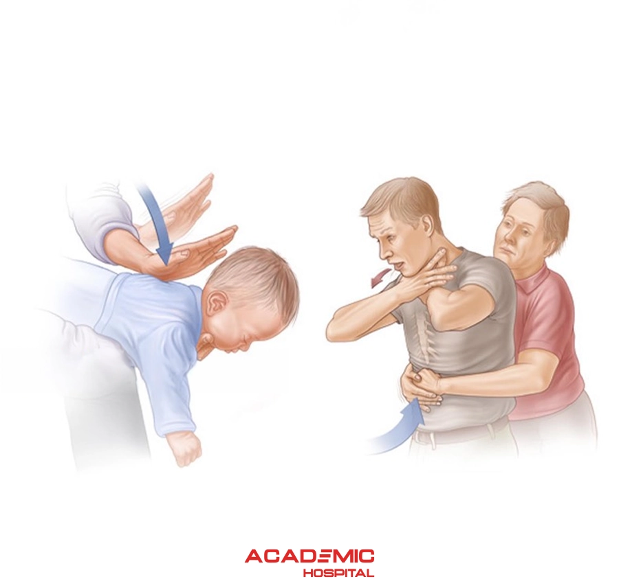 What Is the Heimlich Maneuver and How Is It Performed?