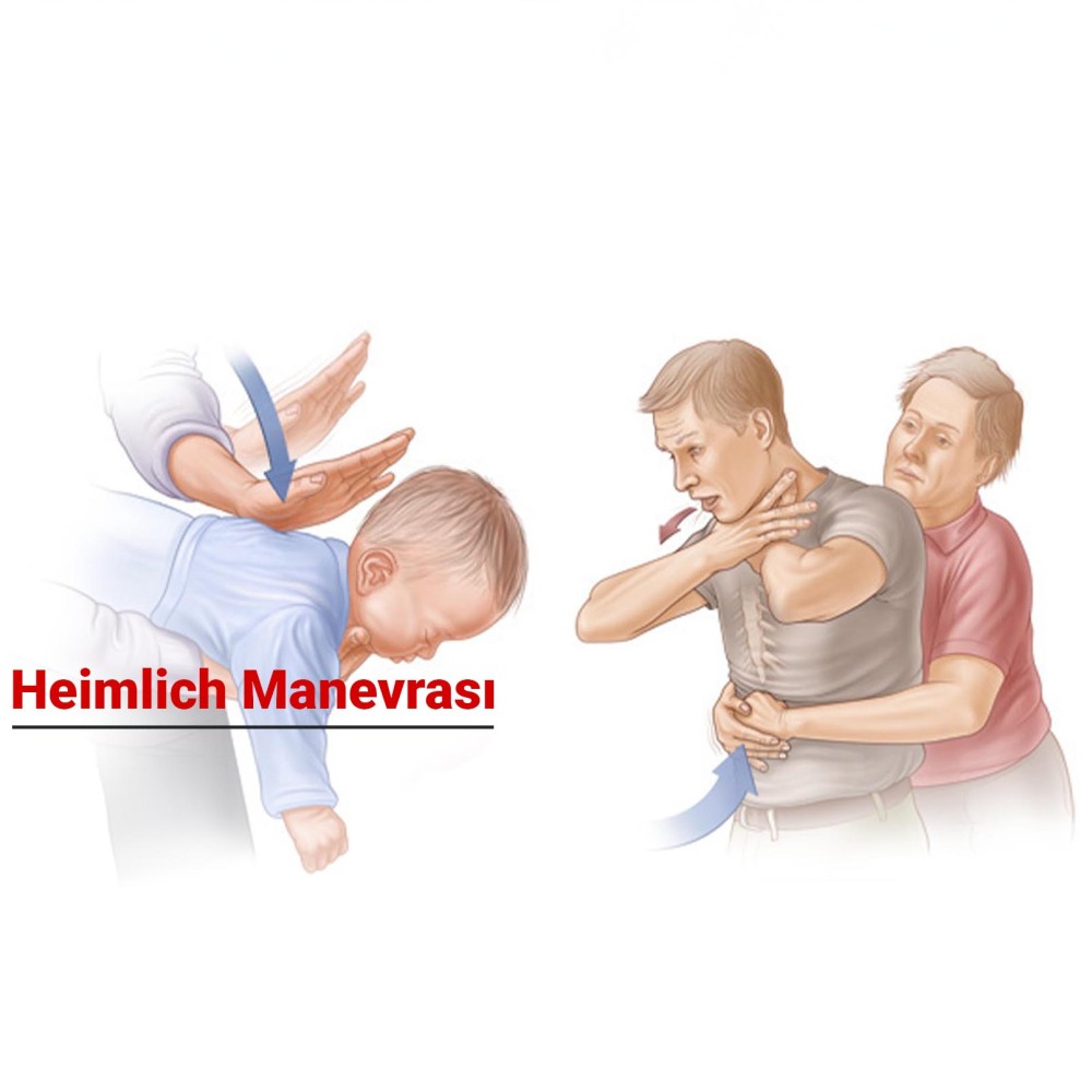 Heimlich Manevrası Nedir ve Nasıl Uygulanır?