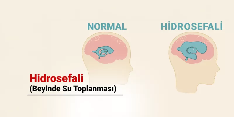 Hidrosefali Nedir? Belirtileri, Nedenleri ve Tedavi Yöntemleri Nelerdir?
