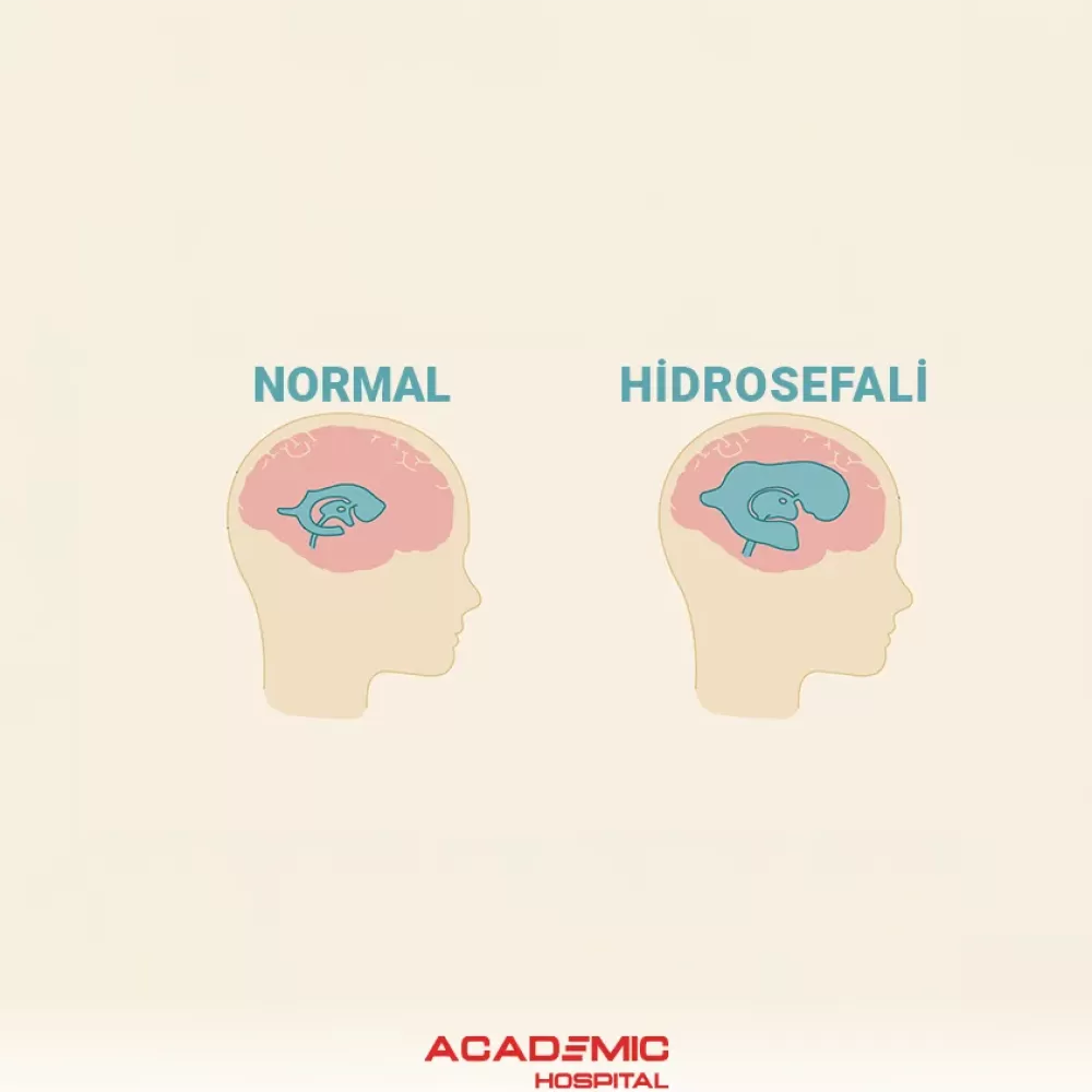 Hidrosefali Nedir? Belirtileri, Nedenleri ve Tedavi Yöntemleri Nelerdir?