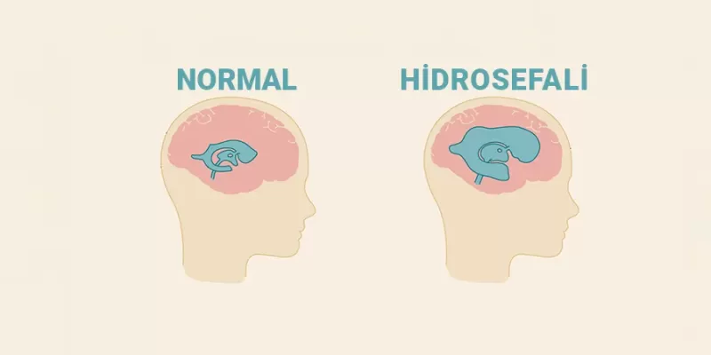 What Is Hydrocephalus? What Are Its Symptoms, Causes, and Treatment Methods?