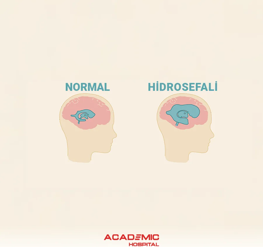 What Is Hydrocephalus? What Are Its Symptoms, Causes, and Treatment Methods?